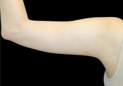 Liposuction to Arms Before & After Patient #2827