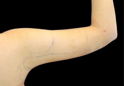 Liposuction to Arms Before & After Patient #2827