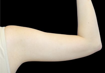 Liposuction to Arms Before & After Patient #2827