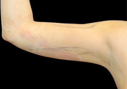 Liposuction to Arms Before & After Patient #2827