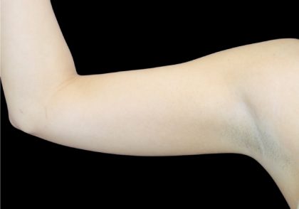 Liposuction to Arms Before & After Patient #2827