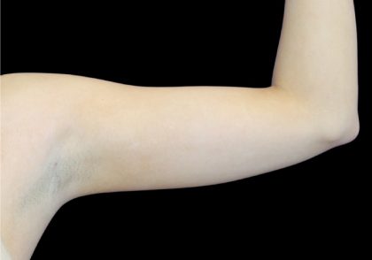 Liposuction to Arms Before & After Patient #2827