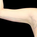 Liposuction to Arms Before & After Patient #2836
