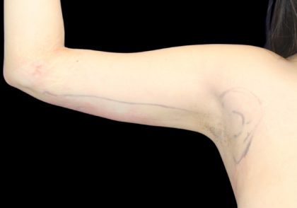 Liposuction to Arms Before & After Patient #2836