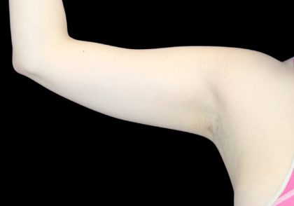 Liposuction to Arms Before & After Patient #2836