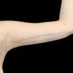 Liposuction to Arms Before & After Patient #2836