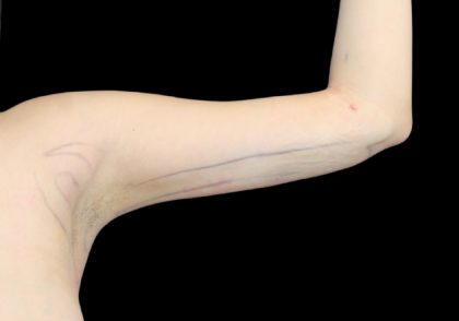 Liposuction to Arms Before & After Patient #2836