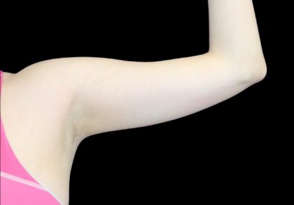 Liposuction to Arms Before & After Patient #2836