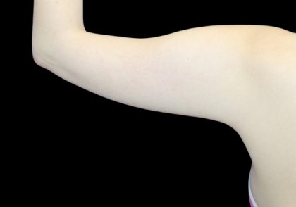 Liposuction to Arms Before & After Patient #2836