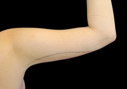 Liposuction to Arms Before & After Patient #2836