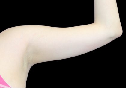 Liposuction to Arms Before & After Patient #2836