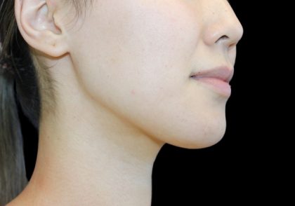 Neck Liposuction Before & After Patient #2845