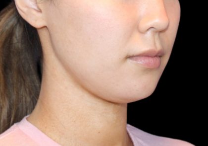 Neck Liposuction Before & After Patient #2845