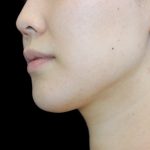 Neck Liposuction Before & After Patient #2845