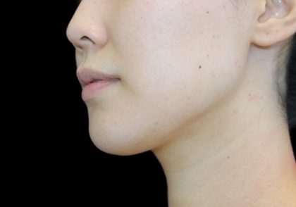 Neck Liposuction Before & After Patient #2845