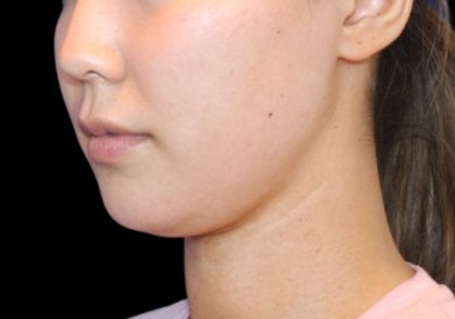 Neck Liposuction Before & After Patient #2845