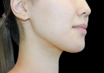 Neck Liposuction Before & After Patient #2845