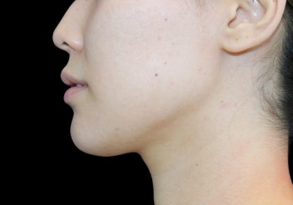 Neck Liposuction Before & After Patient #2845