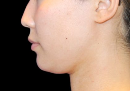 Neck Liposuction Before & After Patient #2845