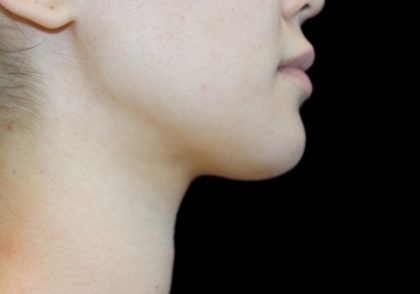 Neck Liposuction Before & After Patient #2845