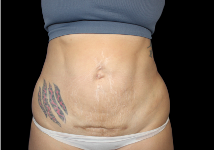 Liposuction Before & After Patient #874