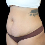 Liposuction Before & After Patient #874