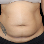 Liposuction Before & After Patient #2802