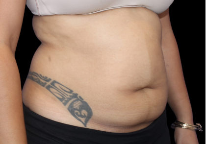 Liposuction Abdomen Before & After Patient #2802