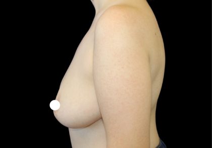 Breast Reduction Before & After Patient #2800