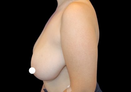 Breast Reduction Before & After Patient #2800