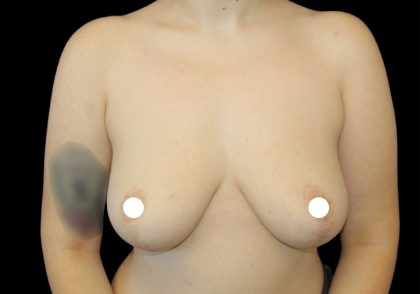 Breast Reduction Before & After Patient #2800