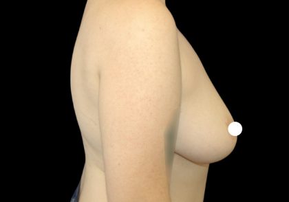 Breast Reduction Before & After Patient #2800