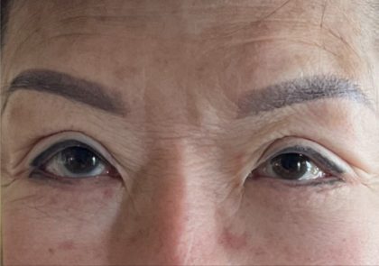 Blepharoplasty Before & After Patient #2496