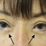 Blepharoplasty Before & After Patient #2496