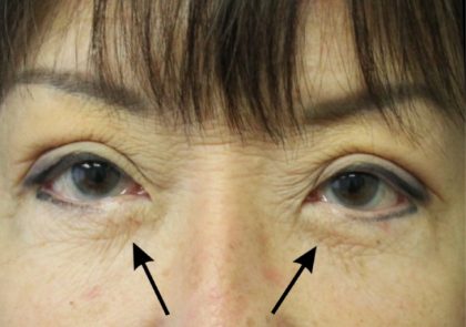 Blepharoplasty Before & After Patient #2496