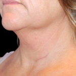 Neck Liposuction Before & After Patient #2799