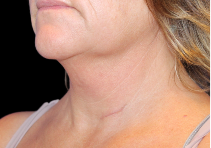 Neck Liposuction Before & After Patient #2799