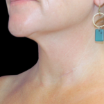 Neck Liposuction Before & After Patient #2799