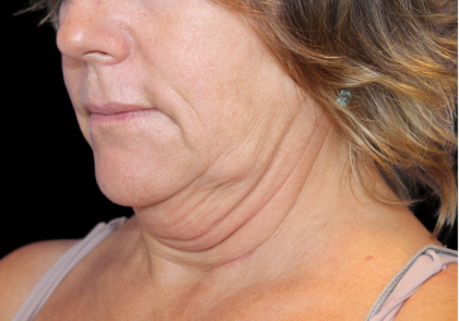 Neck Liposuction Before & After Patient #2799