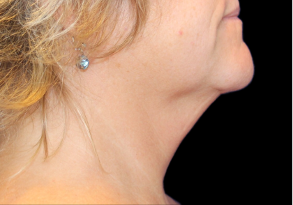 Neck Liposuction Before & After Patient #2799