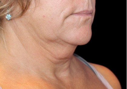 Neck Liposuction Before & After Patient #2799