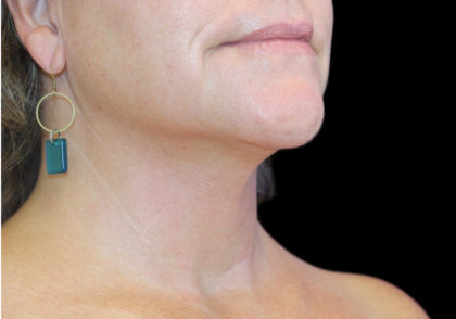 Neck Liposuction Before & After Patient #2799