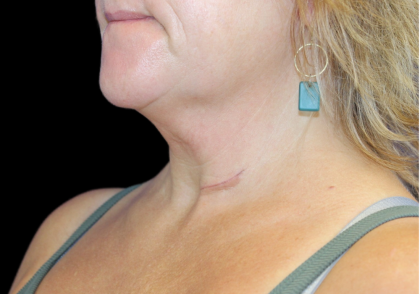 Neck Liposuction Before & After Patient #2799