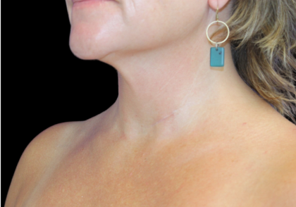 Neck Liposuction Before & After Patient #2799