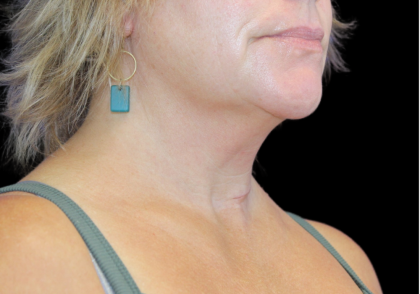 Neck Liposuction Before & After Patient #2799