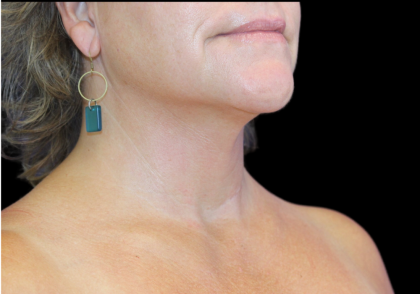 Neck Liposuction Before & After Patient #2799