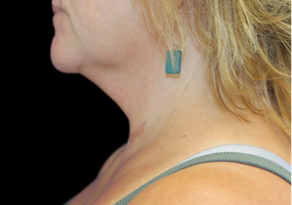 Neck Liposuction Before & After Patient #2799