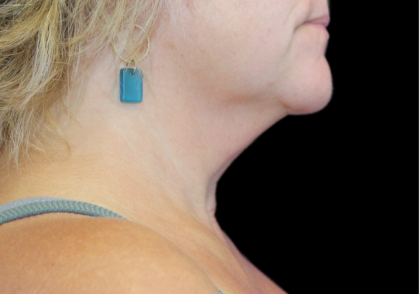 Neck Liposuction Before & After Patient #2799