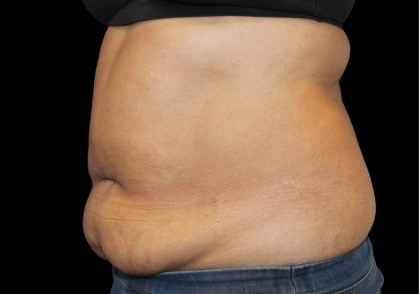 Liposuction Abdomen Before & After Patient #2801