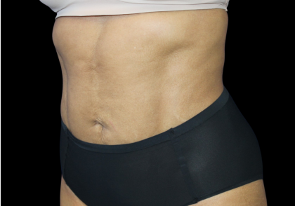 Liposuction Abdomen Before & After Patient #2801